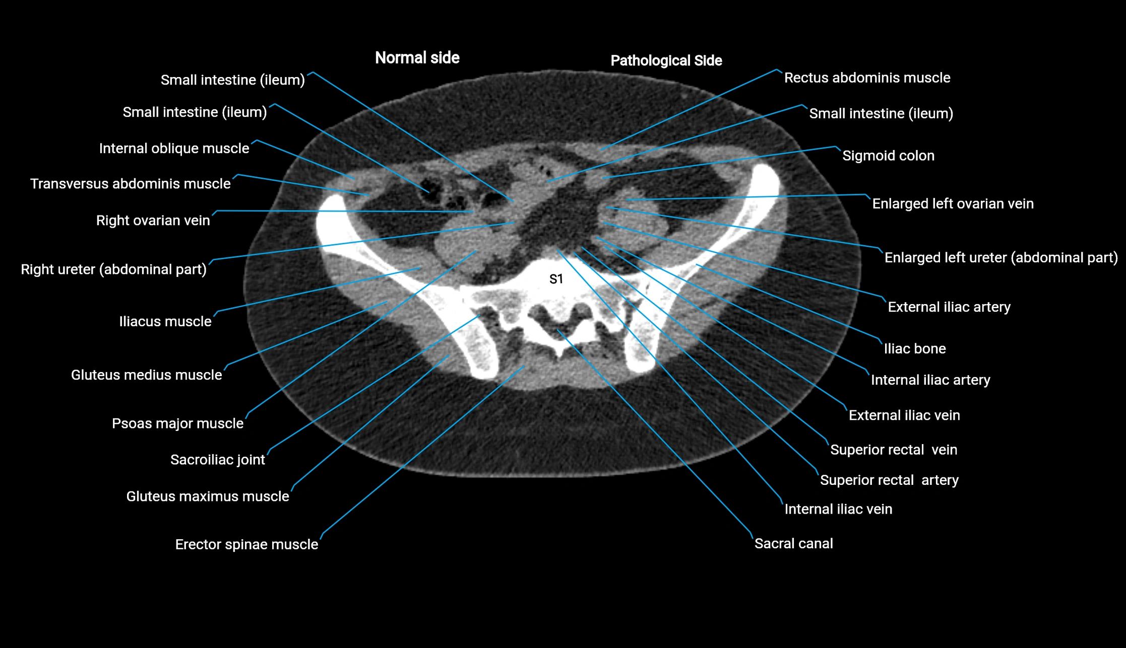 CT KUB axial cross sectional anatomy  radiology image -img-00201-00116.webp